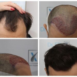 implant par